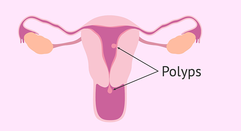 Phân biệt polyp tử cung và u xơ tử cung